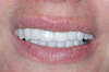 Facettes dentaires cas 17 - après