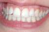 Facettes dentaires cas 22 - après