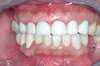 Facettes dentaires cas 23 - après