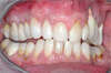 Facettes dentaires cas 30 - après