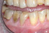 Facettes dentaires cas 31 - après