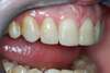 Facettes dentaires cas 34 - après