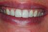Facettes dentaires cas 35 - après