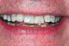 Facettes dentaires cas 36 - après