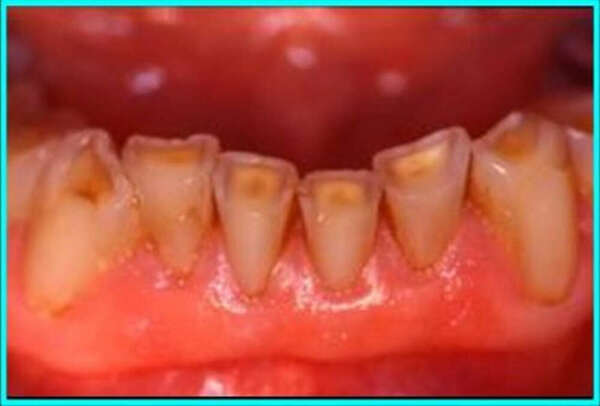 Usures dentaires, un phénomème trop souvent ignoré