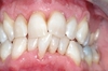Blanchiment dentaire cas 1 - après