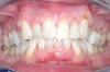 Blanchiment dentaire cas 2 - après