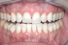Blanchiment dentaire cas 6 - après
