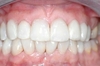 Facettes dentaires cas 2 - après