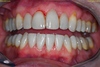 Facettes dentaires cas 39 - après