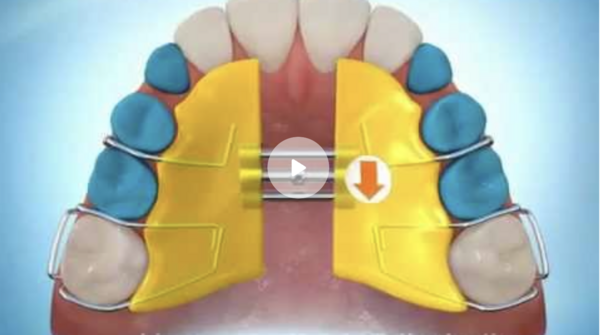 Plaque à vérin maxillaire dolphin