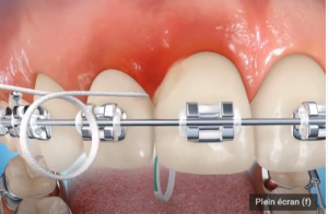 Nettoyage des brackets avec du fil dentaire