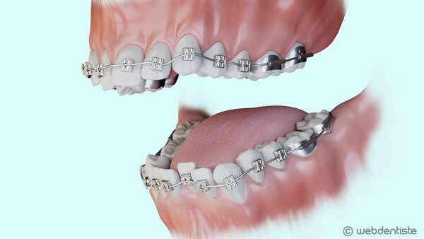 Traitement multi-attaches