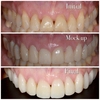 Alignement par invisalign avant et après