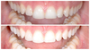 Alignement par invisalign avant et après