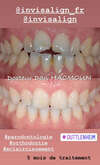 traitement invisalign avant et apres