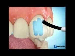 Collage des brackets