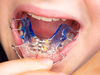 Appareils Amovibles, orthodontie interceptive, cabinet du dr robin collinot