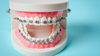 brackets métalliques, orthodontie classique, cabinet du dr robin collinot