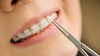 bagues céramiques, orthodontie classique, cabinet du dr robin collinot