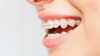 brackets céramiques, orthodontie classique, cabinet du dr robin collinot