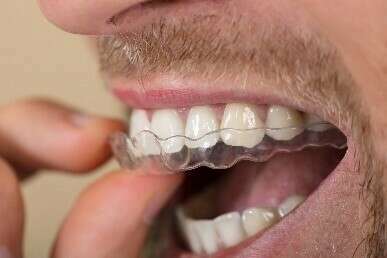 Orthodontie Invisible : le traitement par gouttières