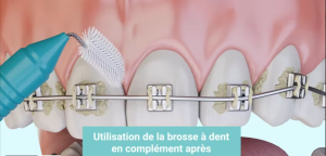Brossages des brackets
