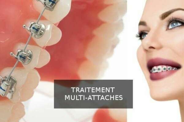 Le traitement Multi-attaches