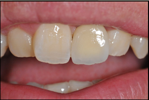 Prothèses sur implant