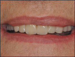 Réalisation d'un Bridge esthétique