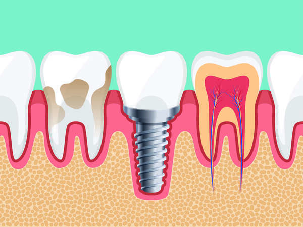  Implants dentaires – Une solution efficace et durable pour remplacer une dent manquante