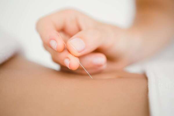 Dry Needling : quelques aiguilles peuvent-elles vraiment soulager vos tensions musculaires ?