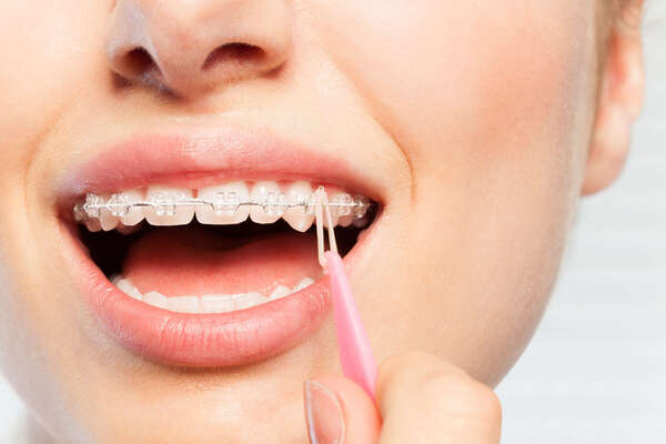 Les élastiques en orthodontie