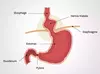 Reflux Gastro-Oesophagien