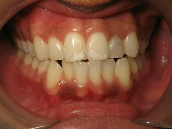 Le blanchiment dentaire