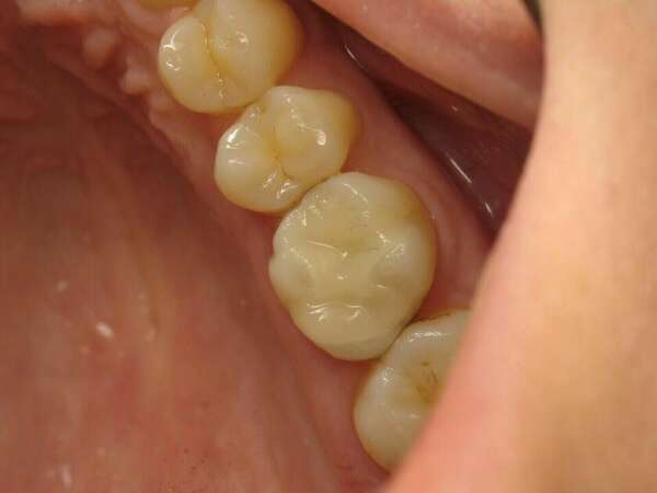 L'Inlay en céramique