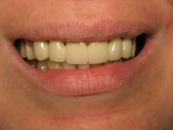 Cas de réhabilitation globale