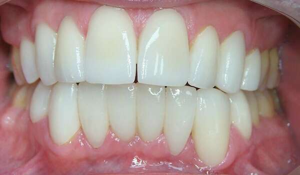 Réalignement des dents et teinte plus claire par la pose de facettes haut et bas - Cas du mois de mars 2016