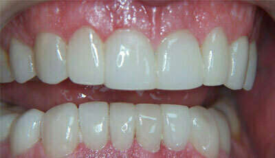 Cas du mois d'octobre - Réalignement des dents par des facette