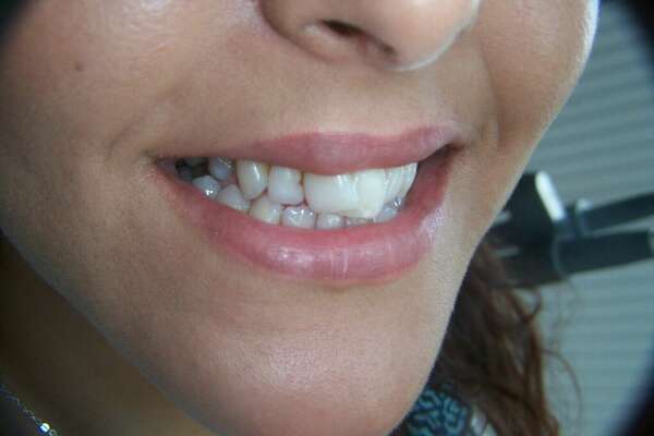 Cas du mois de Septembre 2016 - Facettes sur incisives