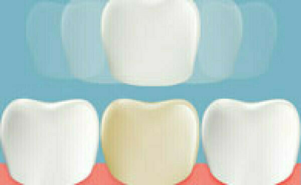 Les facettes céramiques