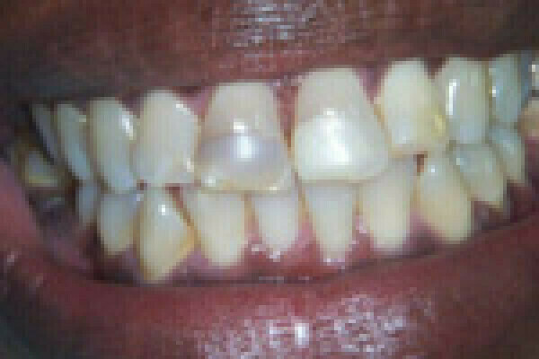  2 facettes suffisent à transformer un sourire