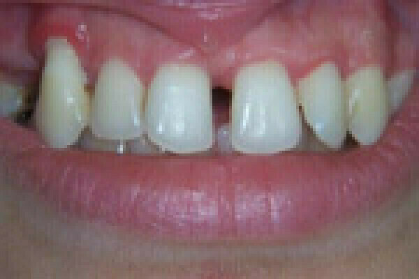 Vidéos et photos d’une réalisation avec transformation complète des gencives et des dents