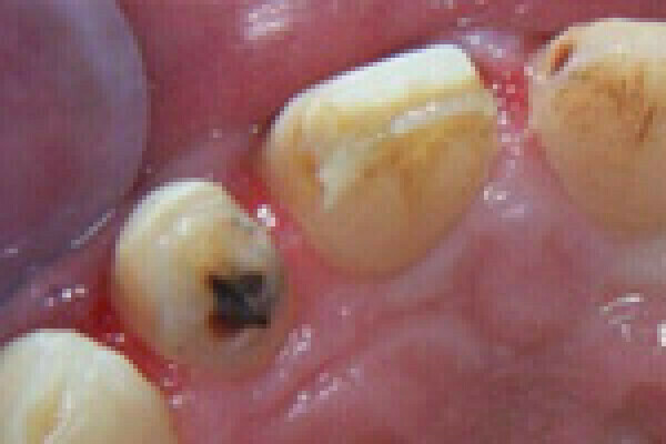 Réalignement des collets des dents