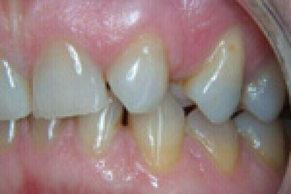 Transformation d’une canine en incisive et d’une prémolaire en canine