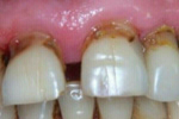 Facettes Dentaires et déchaussement apparent