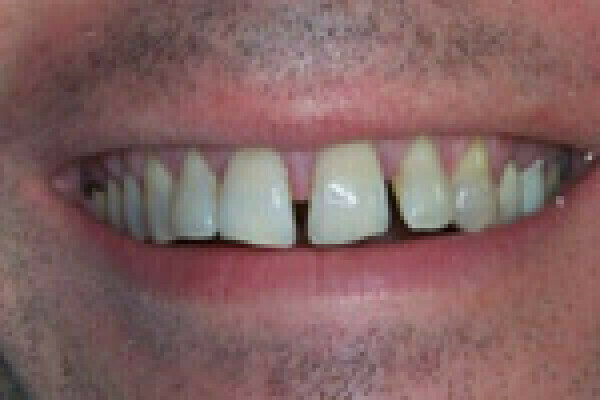 Fermeture des espaces dentaires et soins des gencives en même temps