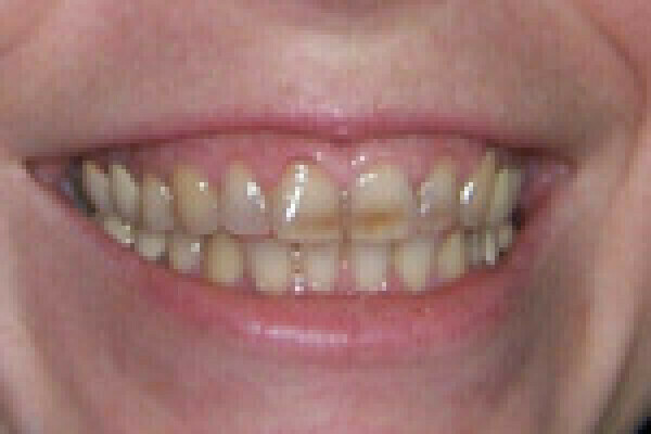 Transformation des gencives et des dents à l’aide de facettes dentaires