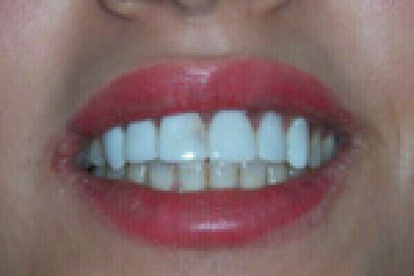 Différence avec facettes sans préparation d’émail et facettes avec préparation