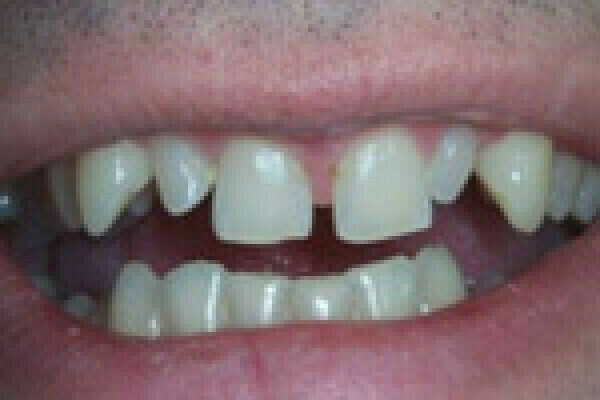 Correction d'une microdontie associée avec des diastèmes à Paris (16)